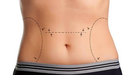 abdominoplastia