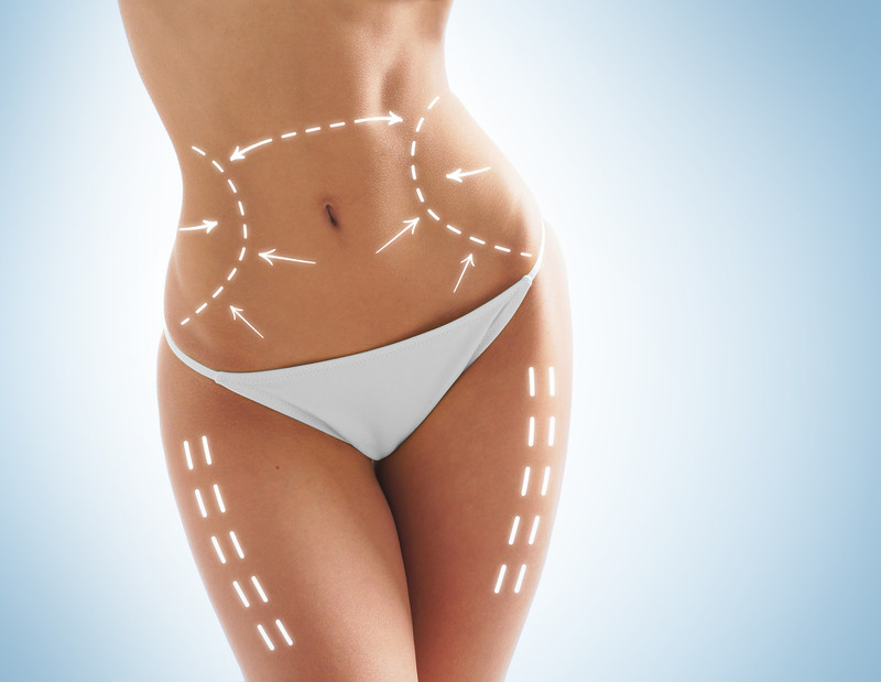 liposuccion